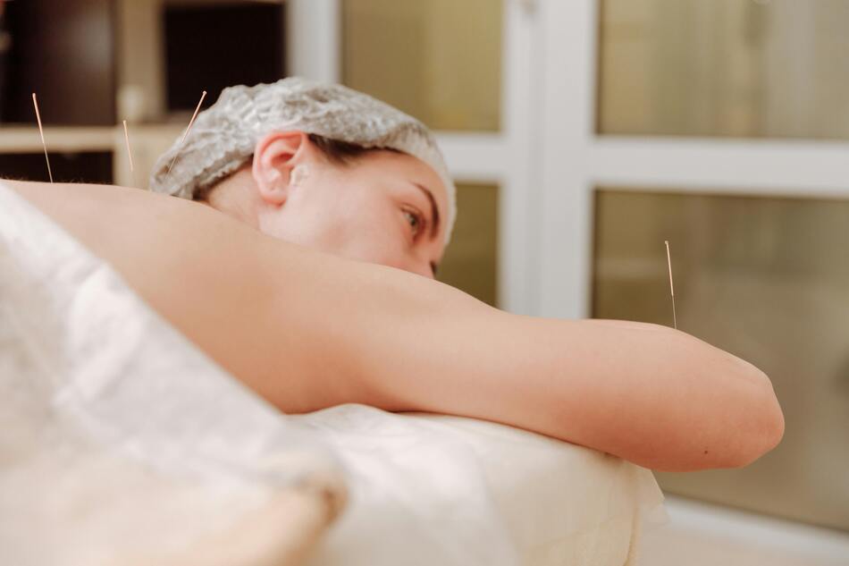 A woman lying down for acupuncture treatment.