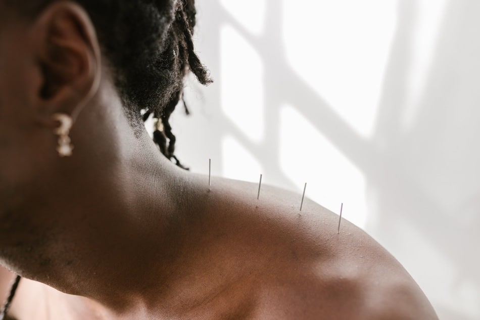 A man undergoing pain management acupuncture treatments for back and neck pain.