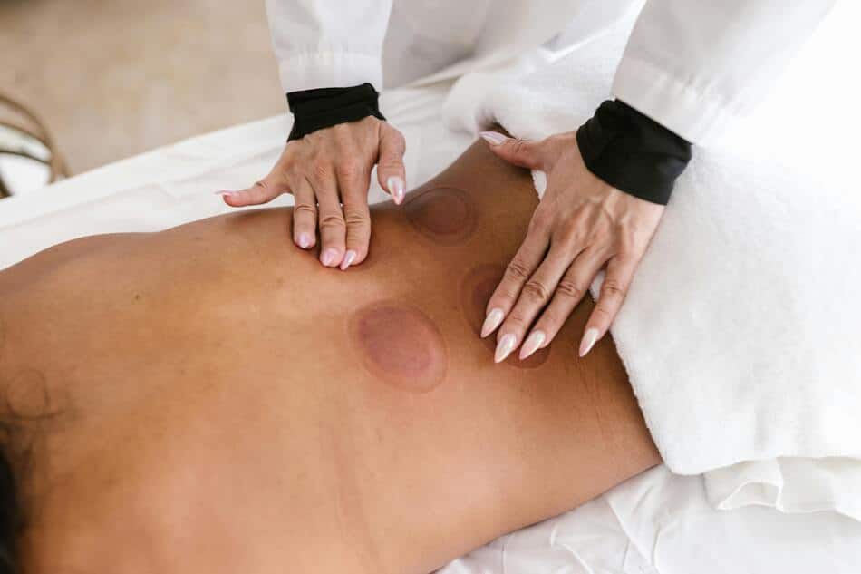 A person with cupping marks on their lower back.