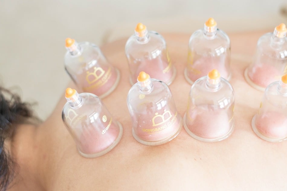 An image of a cupping treatment, therapy that applies similar principles to needleless acupuncture.